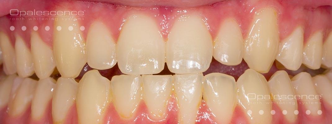 Antes de Blanqueamiento Dental Opalescence