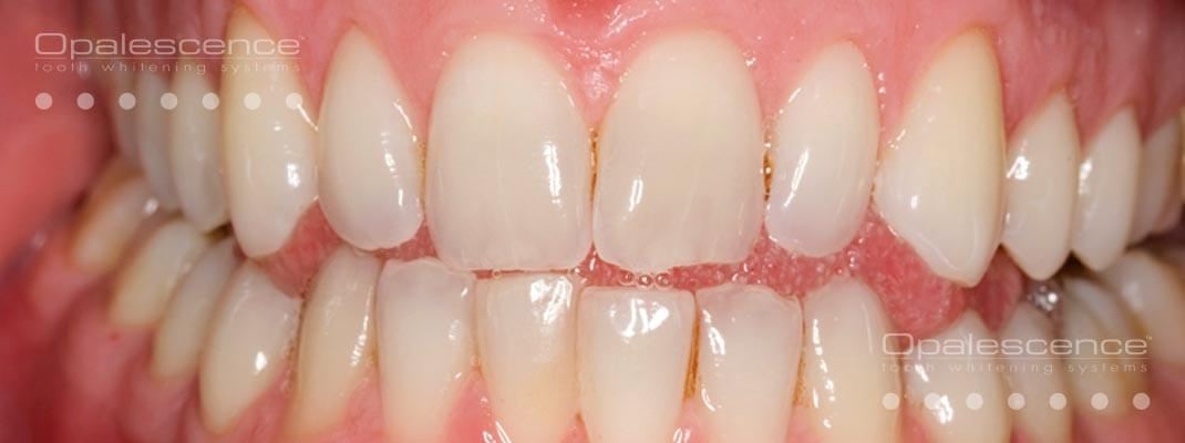 Antes de Blanqueamiento Dental Opalescence